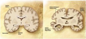Neurodegenerative