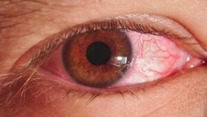 Trachoma