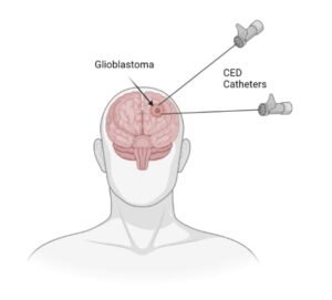 Aggressive brain cancer glioblastoma