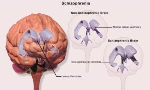New Study Reveals Genetic Link Between Schizophrenia and Osteoporosis