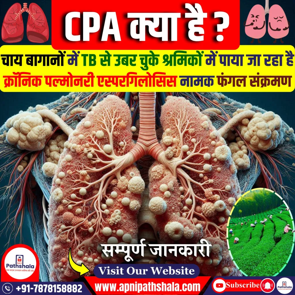 क्रोनिक पल्मोनरी एस्परगिलोसिस