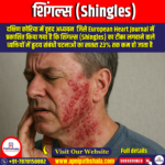शिंगल्स (Shingles) – by Ankit Avasthi Sir