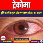 ट्रेकोमा (Trachoma) | Ankit Avasthi Sir