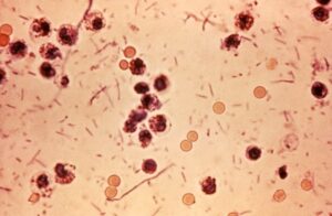 Shigellosis Outbreak