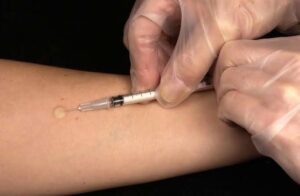 BCG vaccine