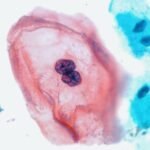 ICMR Validates SHetA2 Therapy For Cervical Disease