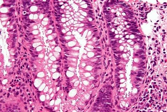 Cyclosporiasis Outbreak