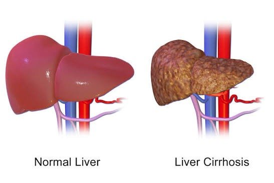 Fatty Liver in Children
